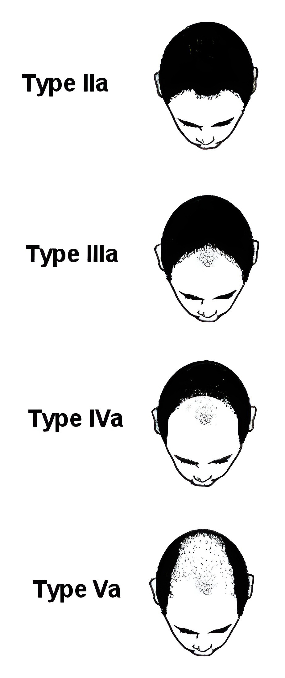 the-norwood-male-pattern-hair-loss-classification-system-keratin